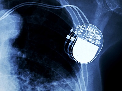Attacchi hacker a pacemaker e defibrillatori: "Troppo vulnerabili, oltre 150-200 violazioni"