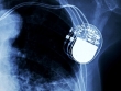 Se hai un pacemaker gli hacker ti possono colpire dritto al cuore